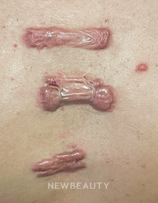 Dr. Anna Chacon – Acne Scarring - 34277144 - Before