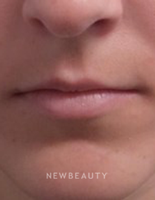 Dr. Marina Peredo - Restylane Silk - Before