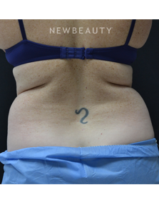 Dr. Julie Russak - CoolSculpting - Before