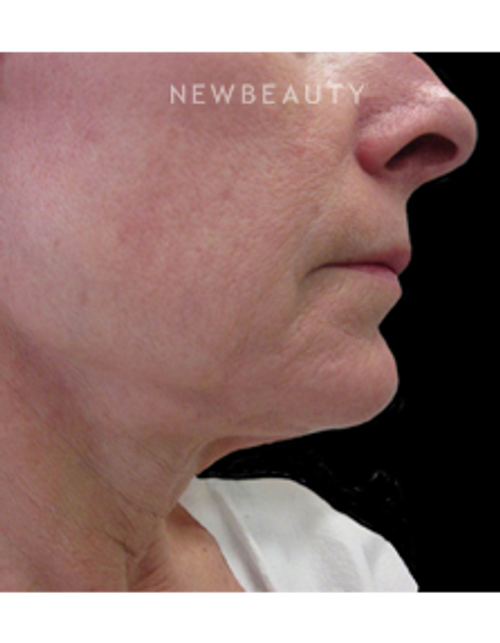 Dr. Kally Papantoniou - Ulthera - Before