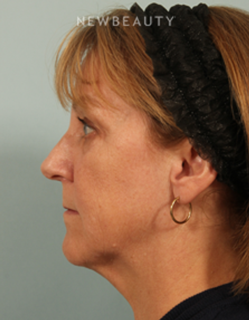Dr. Kenneth Beer - Kybella - After