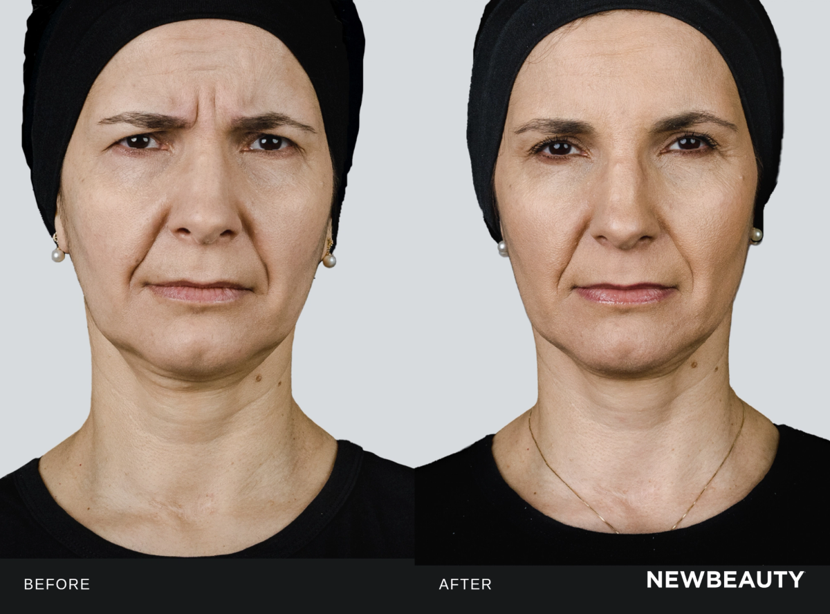 Female patient before and four weeks after Letybo treatment for glabellar lines