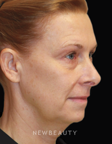 Dr. Dilip Madnani, Facelift - Before