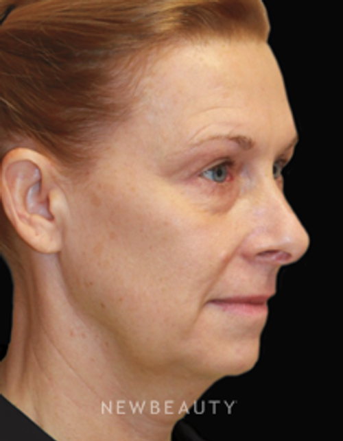 Dr. Dilip Madnani, Facelift - Before