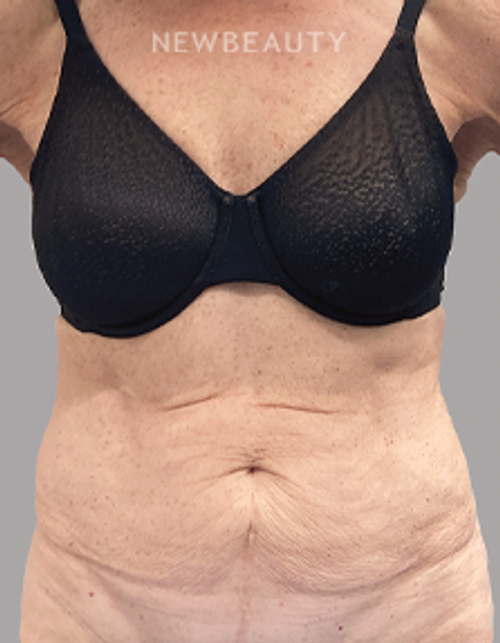 Dr. Christine Hamori – Tummy Tuck – 52892827 - Before