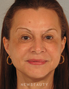 Dr. Henry Mentz Eye Lift, Facelift, Necklift - After