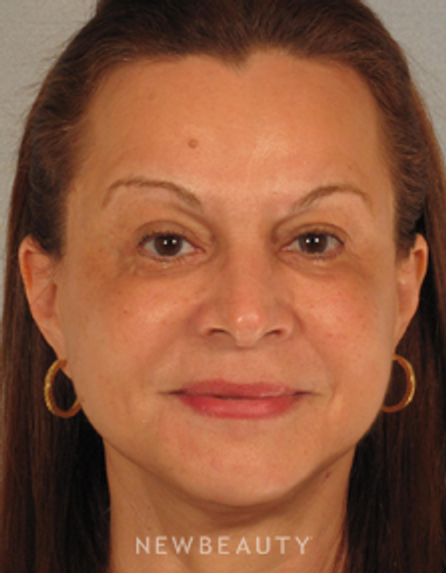 Dr. Henry Mentz Eye Lift, Facelift, Necklift - After