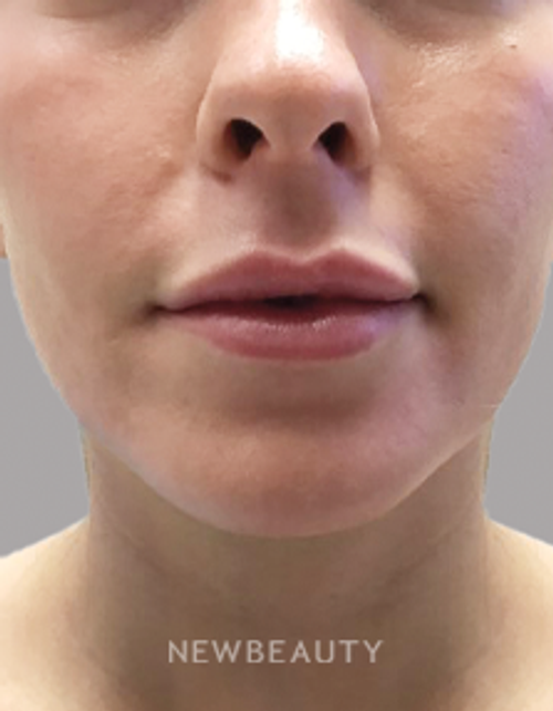 Drs. Elias - Lip Filler - 17150136 - After