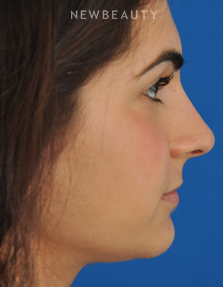 Dr. Edward Kwak - Rhinoplasty - Before