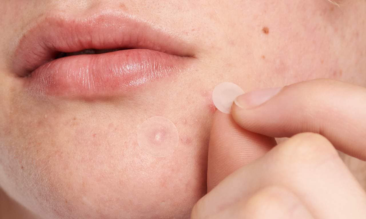 person applying pimple patches to acne on lower face