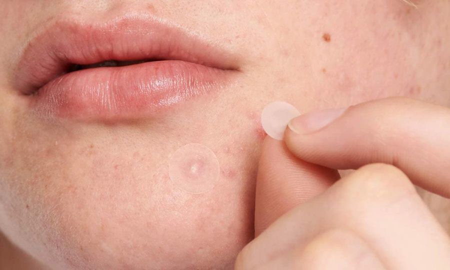 person applying pimple patches to acne on lower face