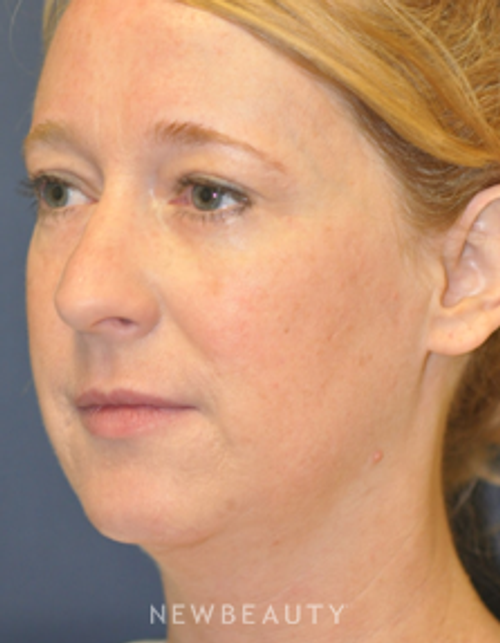 Drs. Lieberman & Parikh - Lower Blepharoplasty - After