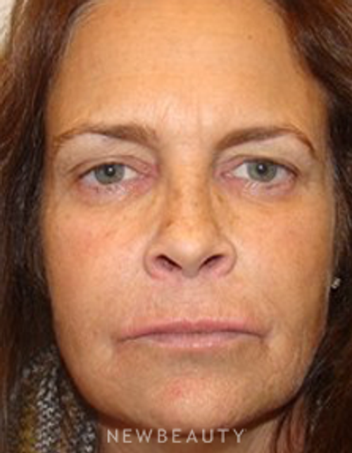 Dr. Joel Schlessinger - Injectables - After