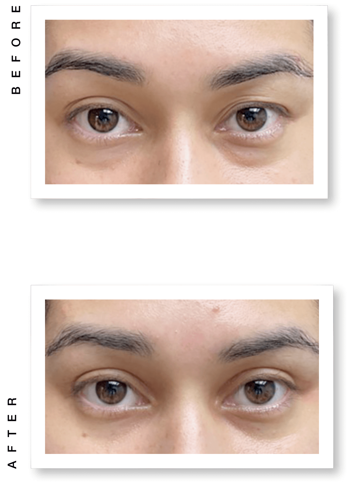 Before and after images of upper blepharoplasty with left medial canthal web-reduction