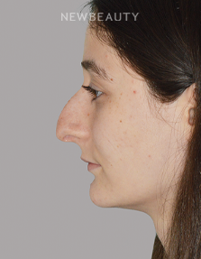 Dr. Anthony Bared - Profile Harmony - 44695544 - Before