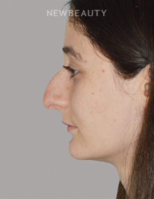 Dr. Anthony Bared - Profile Harmony - 44695544 - Before