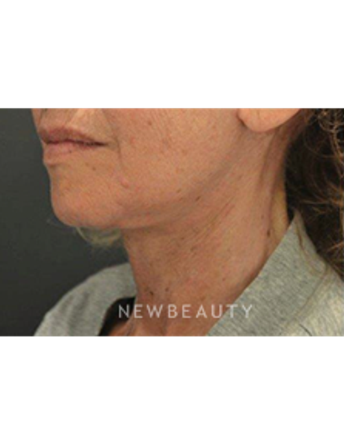 Dr. B. Aviva Preminger - Neck Lift - After