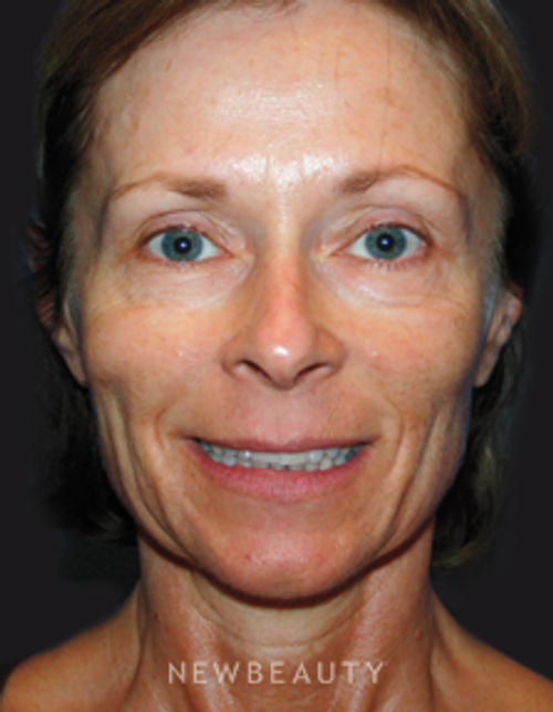 Dr. Kelly Bomer Facelift, Chin Implant, Blepharoplasty, Lip Augmentation, Chemical Peel, IPL - Before