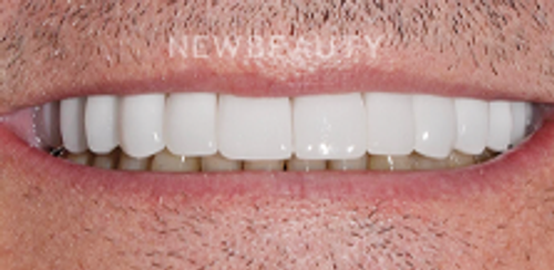 Dr. Salvator La Mastra - Smile Makeover -46106883 - After