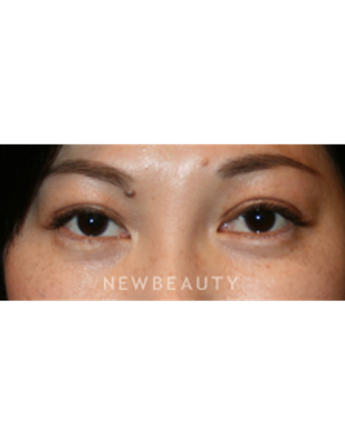 Dr. John Kang - Eyelift - After