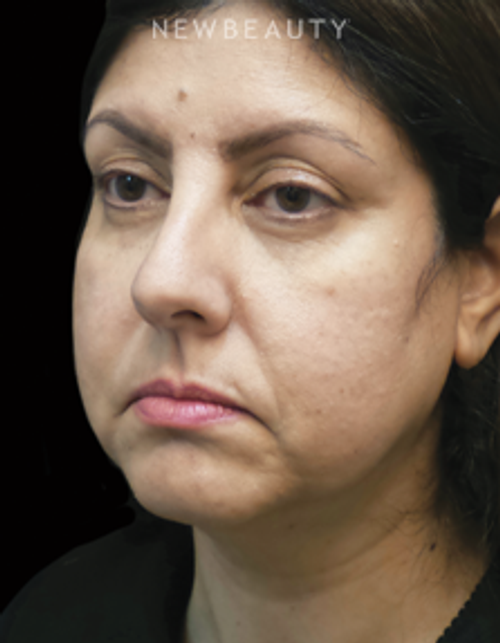 Dr. Adam Summers - Facelift - Before