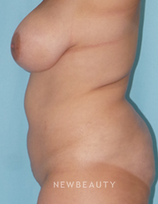 Dr. Sean Simon - Mommy Makeover - Before