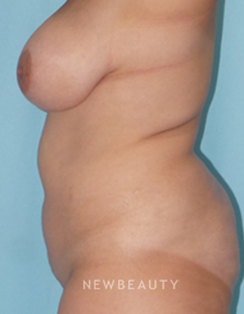 Dr. Sean Simon - Mommy Makeover - Before