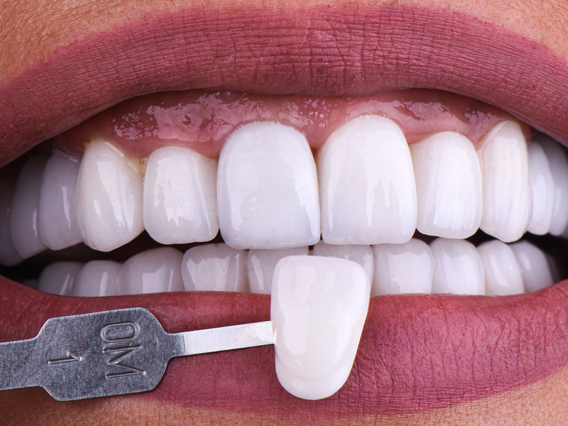 Minimal-Prep Veneers Will Help Preserve Your Smile’s Natural Beauty