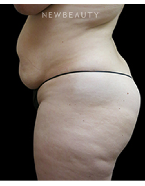 Dr. Elie Levine - Mommy Makeover - Before