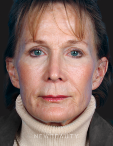 Dr. Kelly Bomer Liquid Lift, Lip Filler, Chemical Peel, Injectables & Fillers - After