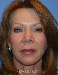 Dr. Kelly Bomer-Liquid Facelift - After