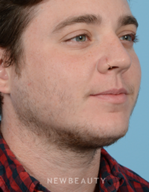 Dr. Jeffrey B. Wise - Hair Transplant - Before