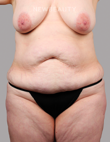 Dr. Chet Mays - Body Sculpting and Tummy Tuck - 35067825 - Before