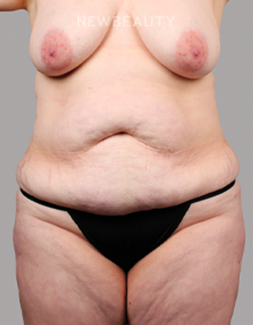 Dr. Chet Mays - Body Sculpting and Tummy Tuck - 35067825 - Before