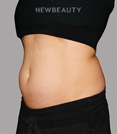 Dr. Linda Honet - CoolSculpting - 22404225 - Before