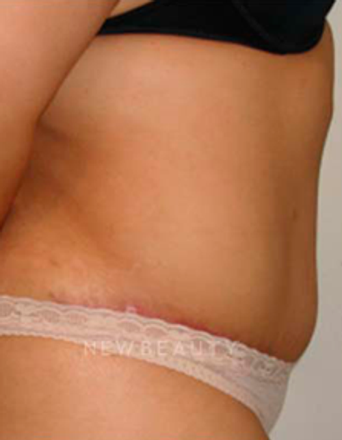 Dr. Michael Horn Tummy Tuck - After
