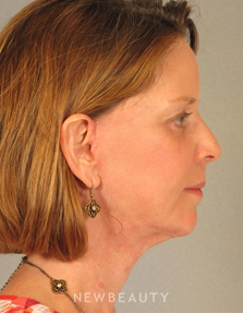 Dr. Henry Mentz Eyelift, Facelift, Necklift - After