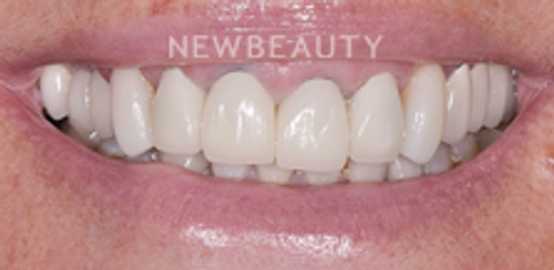 Dr. Salvator La Mastra - Smile Makeover - 46106681 - Before