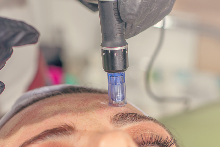 microneedlinghiv