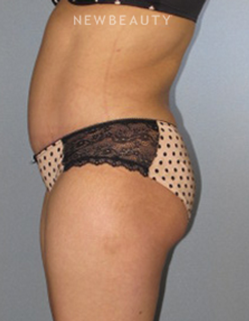 Dr. German Newall - Slimmer Profile - After