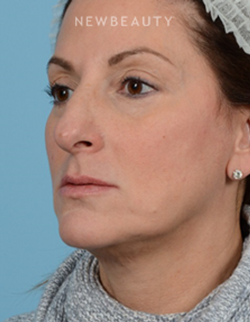 Dr. Jeffrey Wise - Rhinoplasty - Before