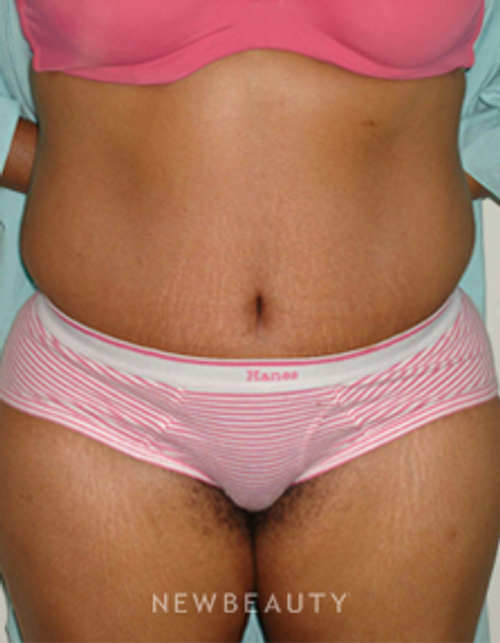 Dr. Michael Horn Tummy Tuck - After