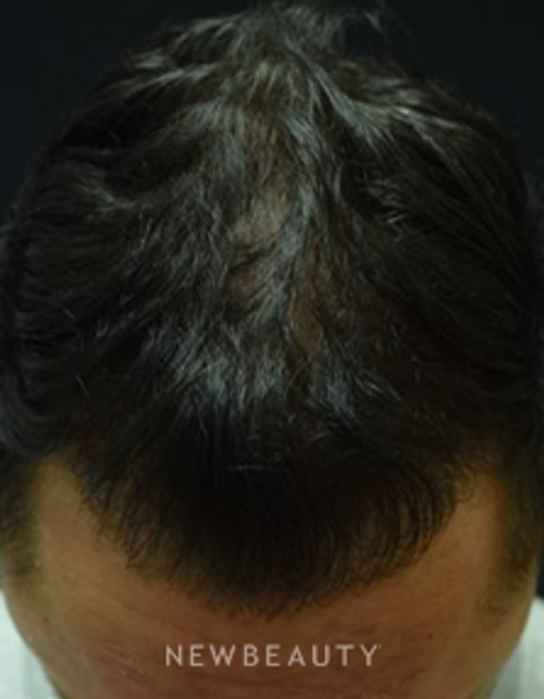 Dr. Jeffrey B. Wise - Hair Transplant - After