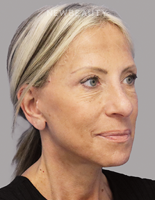 Dr. Dilip Madnani - Facelift -  45284088 - After
