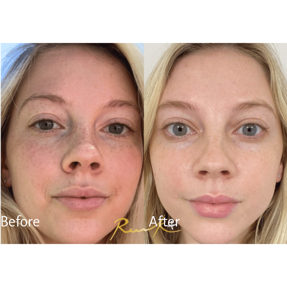Dr. Russak reversed sun damage with a chemical peel.