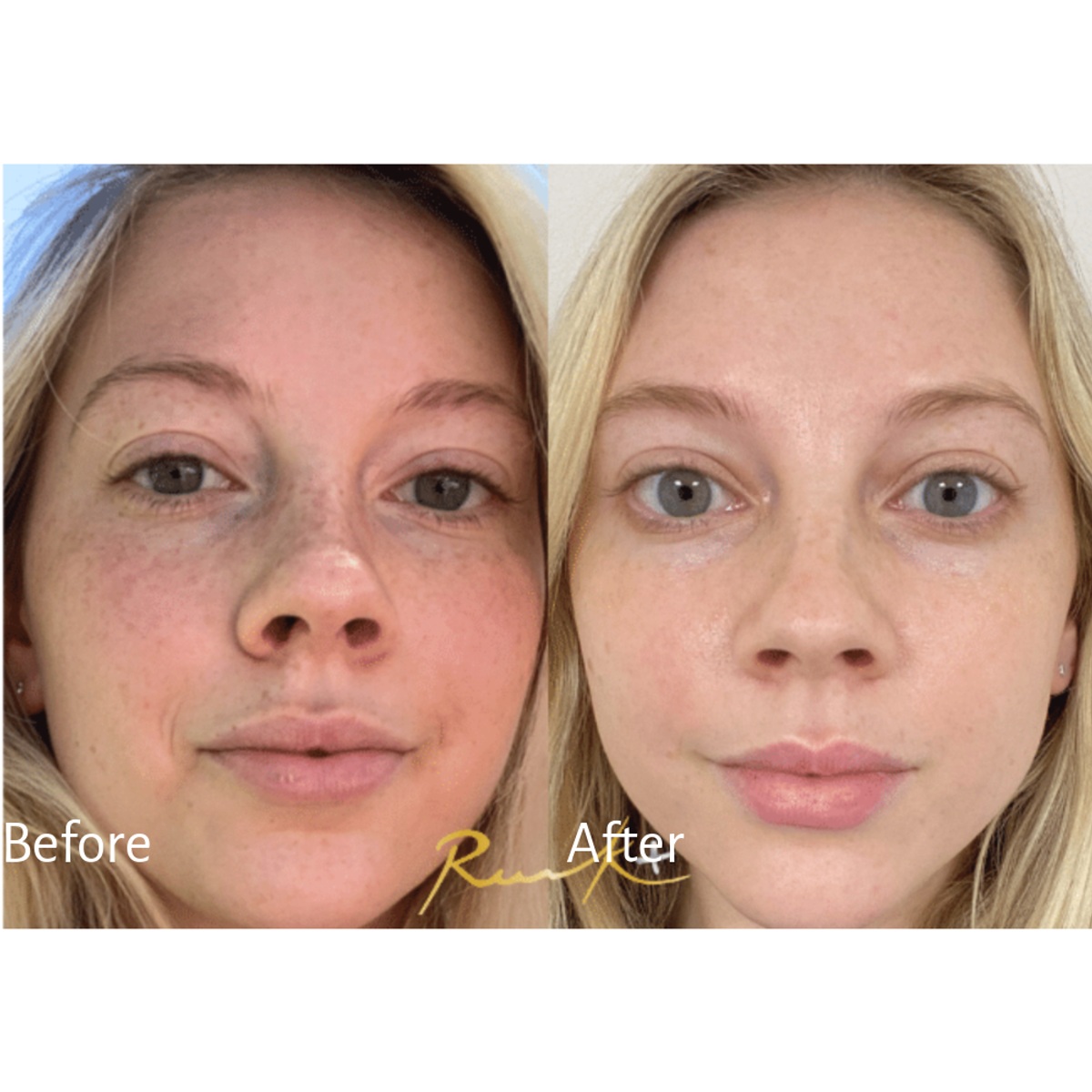 Dr. Russak reversed sun damage with a chemical peel.
