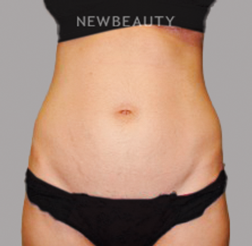 Dr. Sanjay Grover - Liposuction - 49728195 - Before