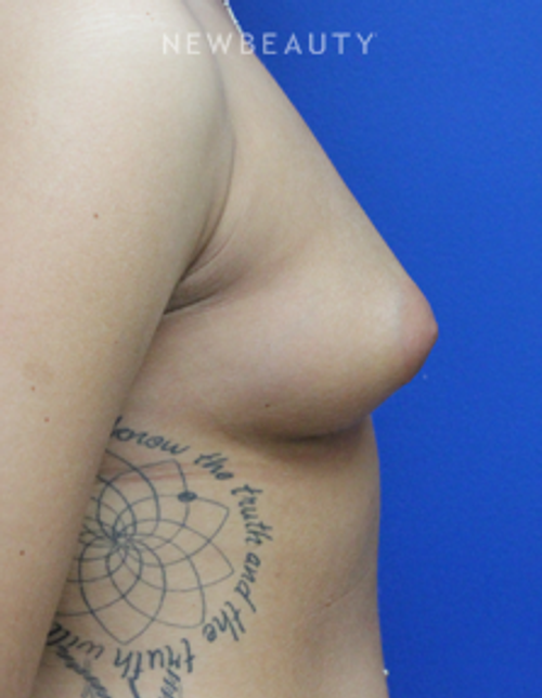 Dr. Joseph Russo - Enhancing Curves (Breast EBG) - Before