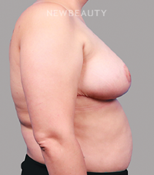Dr. Michael Lofgren-Breast Reduction-44688490 - After