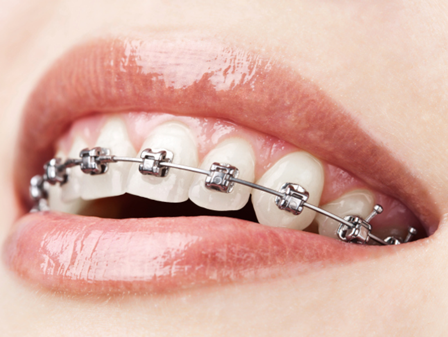 braces Main Newbeauty